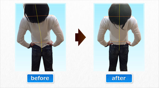 腰を後ろに反ると痛みが出るというBさん。